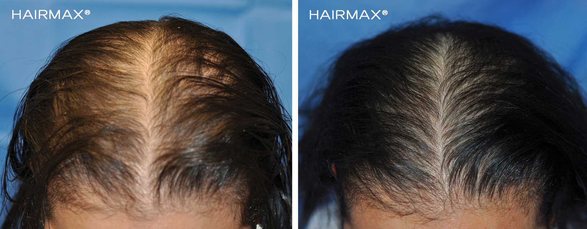 Волосы выпадают после лечения. HAIRMAX LASERBAND 82. Выпадение волос до и после. Мезотерапия волос до и после.
