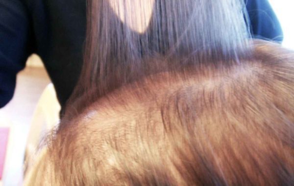 Common Causes of Hair Loss in Your 20’s and 30’s Hairatin®