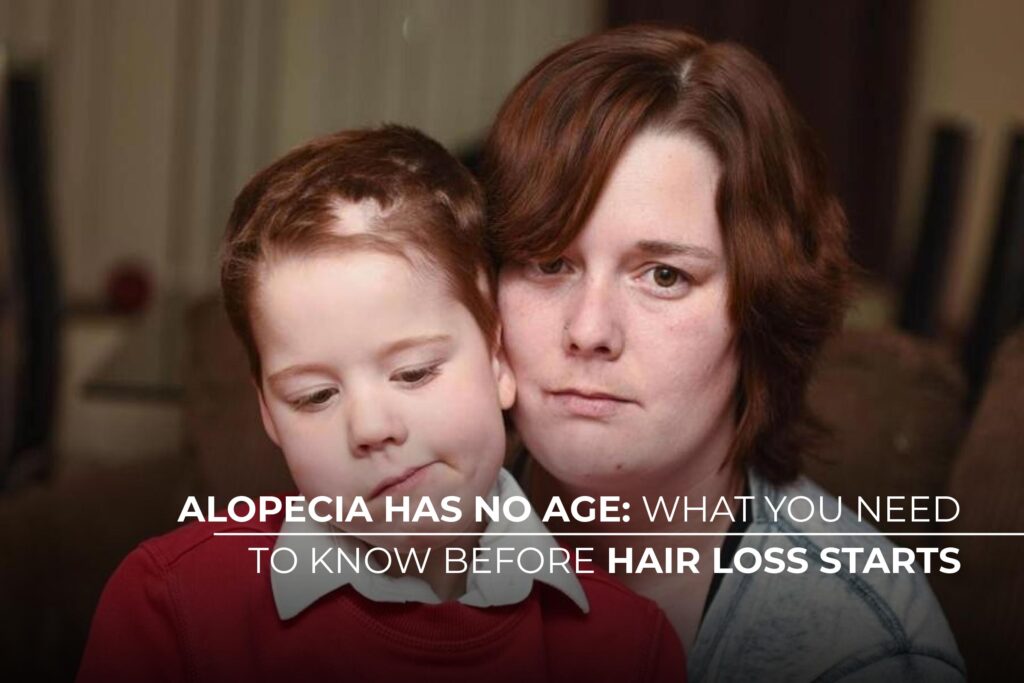 Alopecia has no age