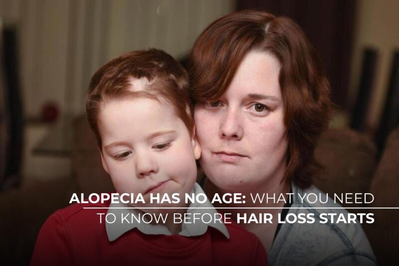 Alopecia has no age