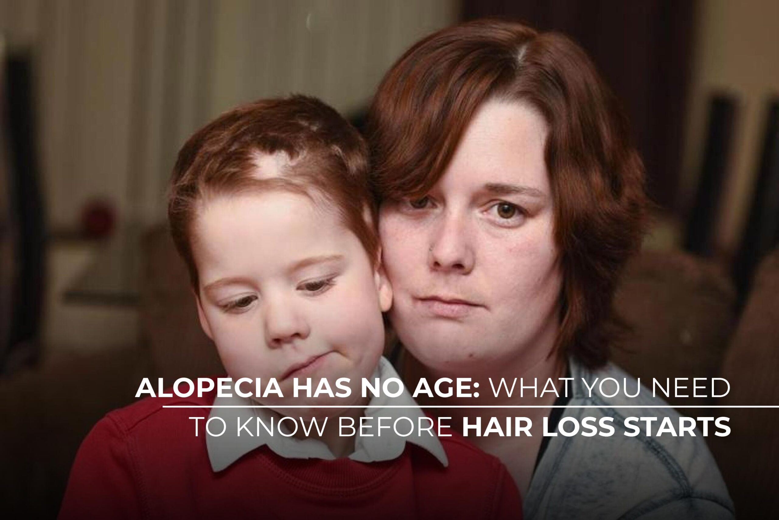 Alopecia has no age