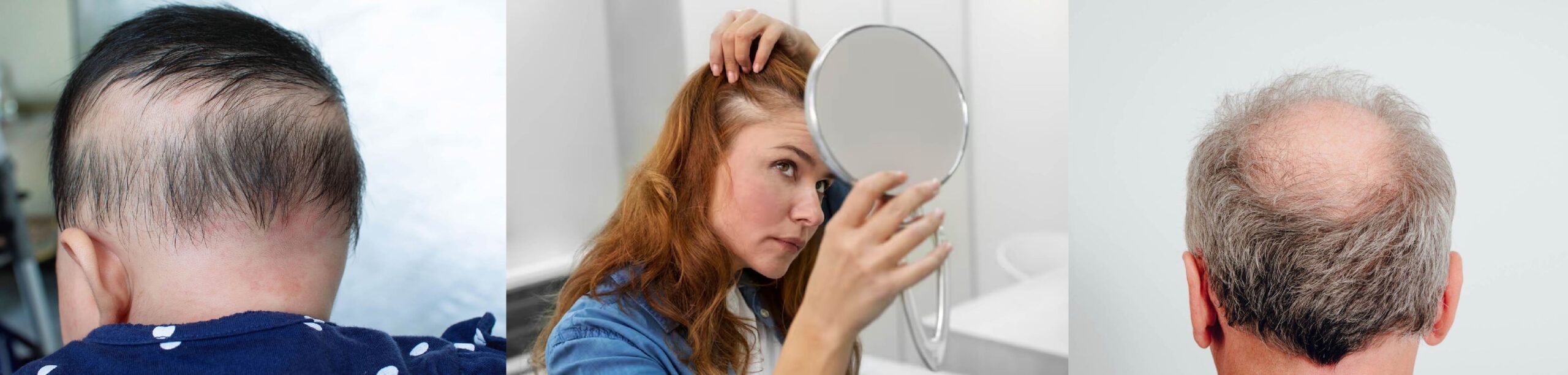 alopecia has no age